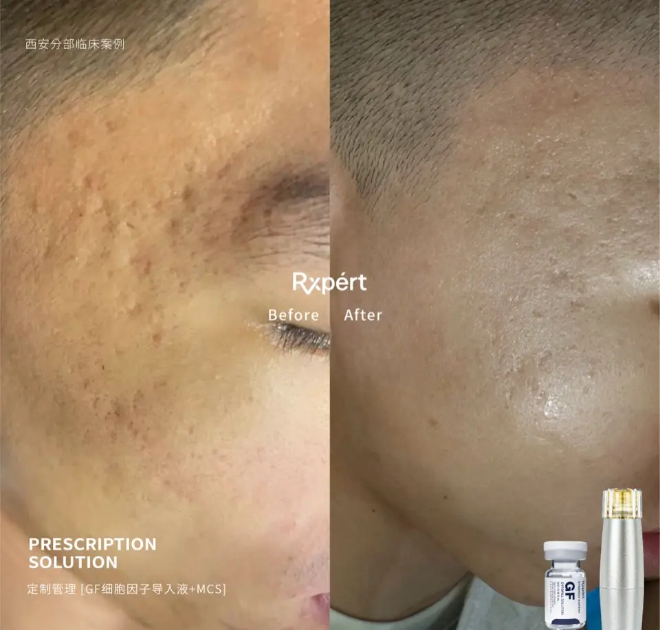 Before and after: acne marks and uneven texture, GF Cytofill and MCS prescription