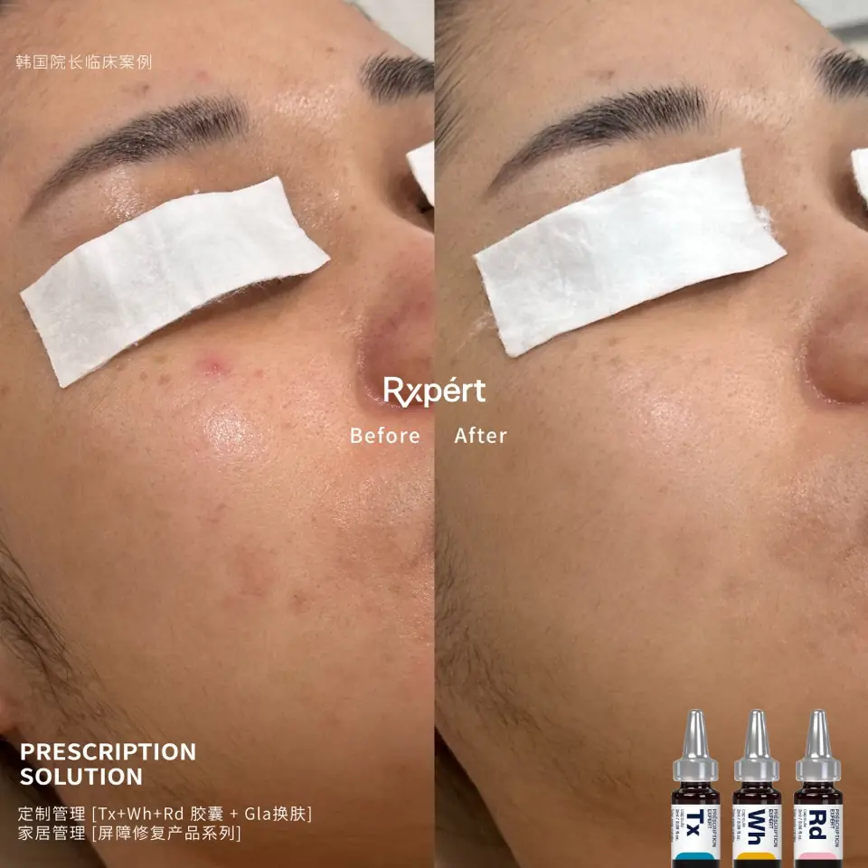 Before and after: redness and a single blemish, Tx, Wh and Rd capsules with Gla peel