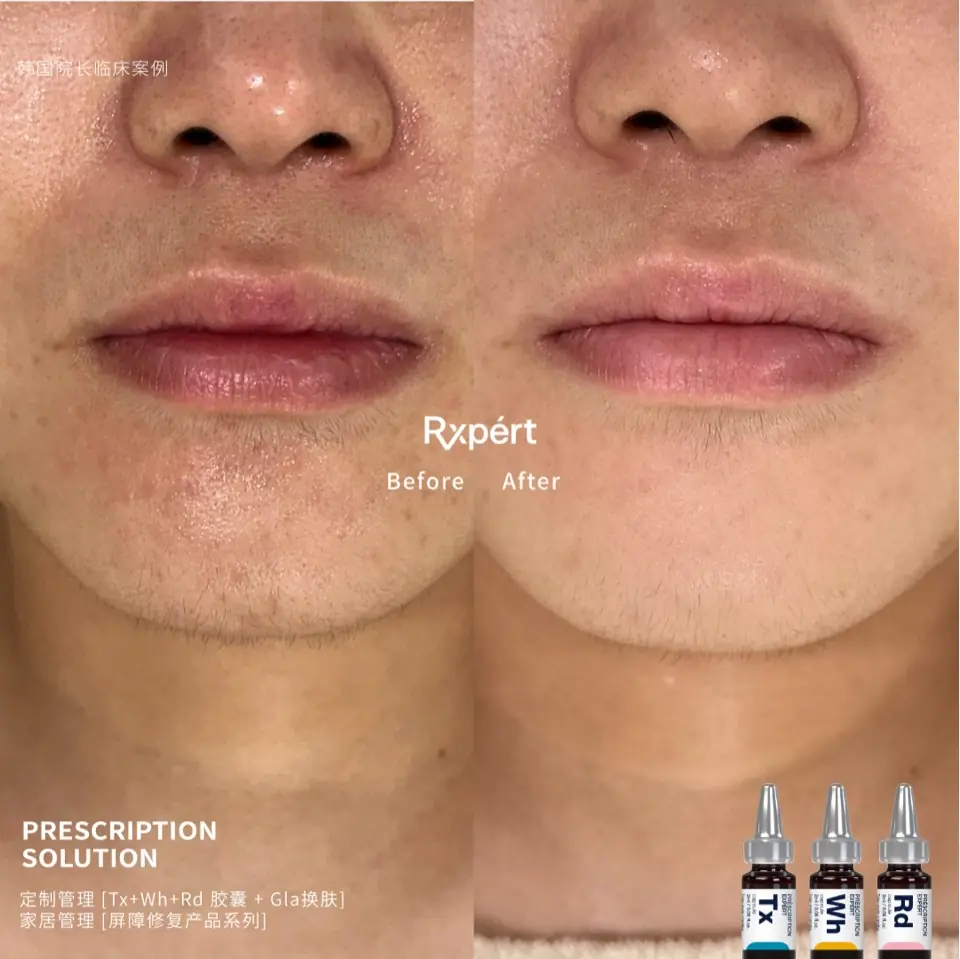 Before and after: irritation around the chin, Tx, Wh and Rd capsules with Gla peel
