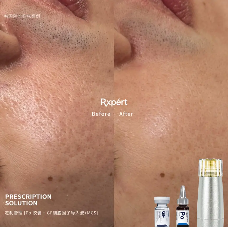 Before and after: enlarged pores and uneven tone, Po capsule with GF Cytofill and MCS