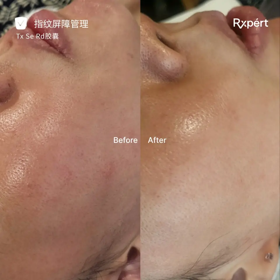 Before and after: oily, reactive skin, Tx, Se and Rd capsules fingerprint barrier management
